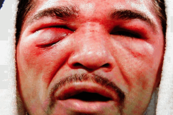 antonio-margarito-eye_crop_north